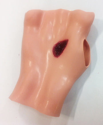 Queimadura de fósforo na mão