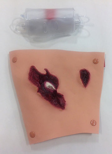 Fratura Composta de Fêmur