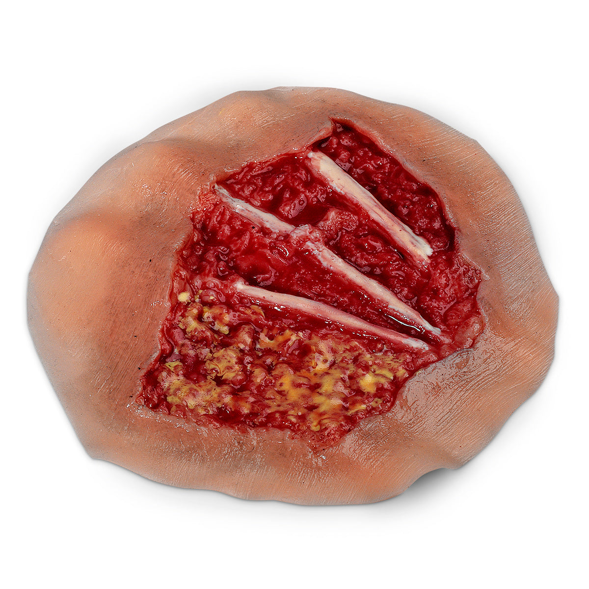Queimadura, Dorso da Mão, 4º Grau